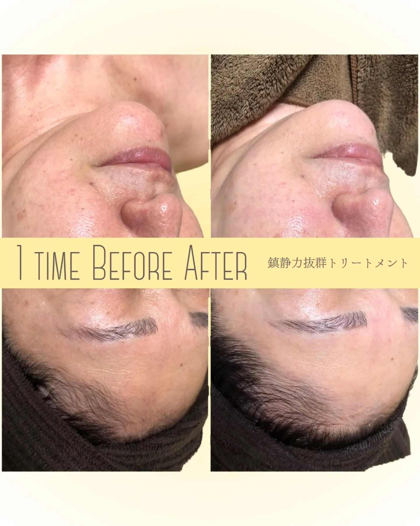 【美肌の道は鎮静の1歩から】