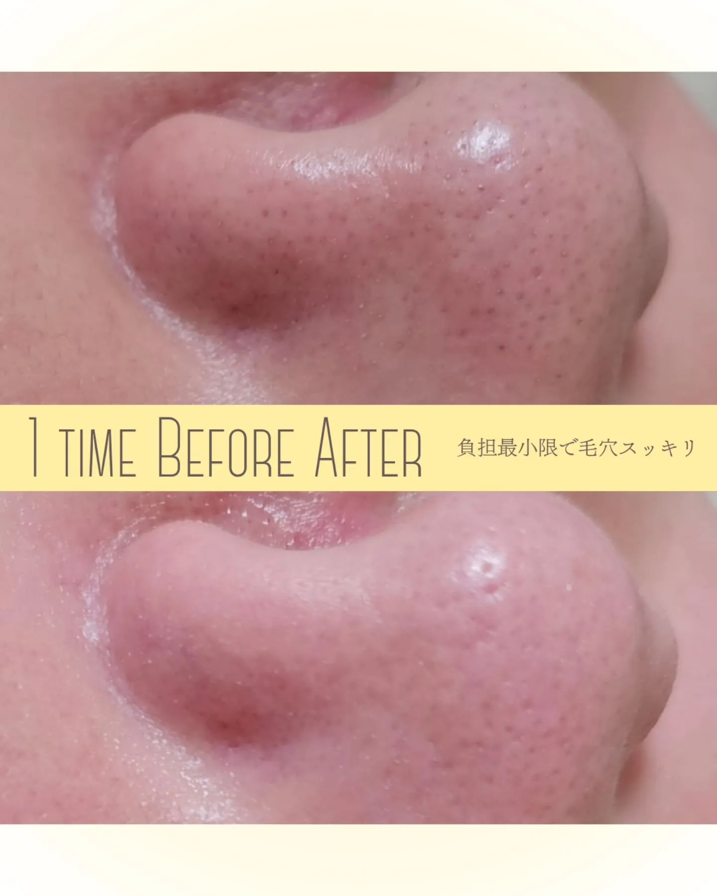 【毛穴の圧しだし論争】