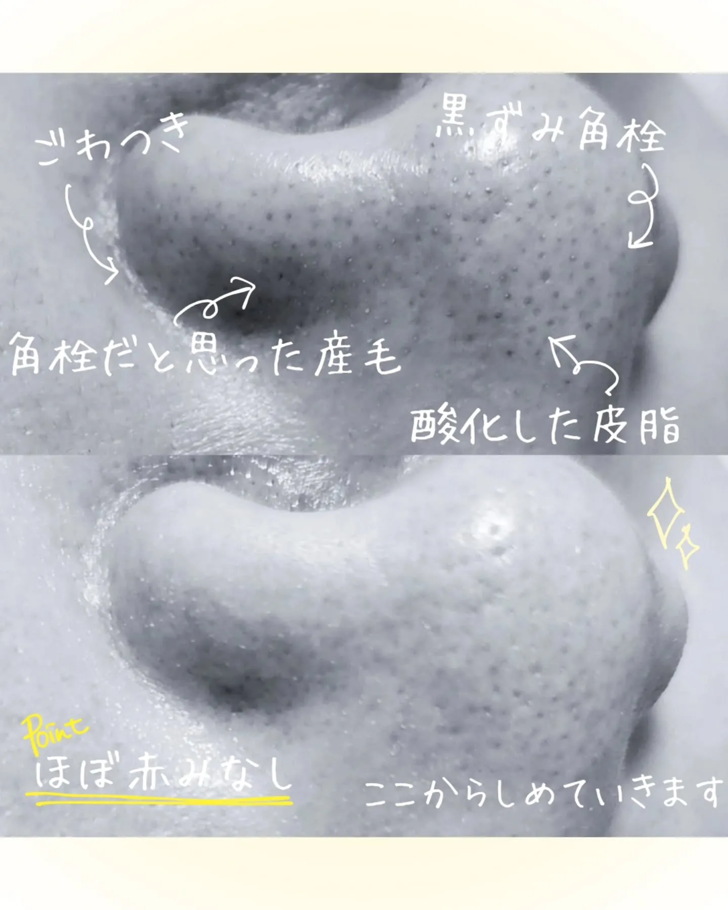 【毛穴の圧しだし論争】