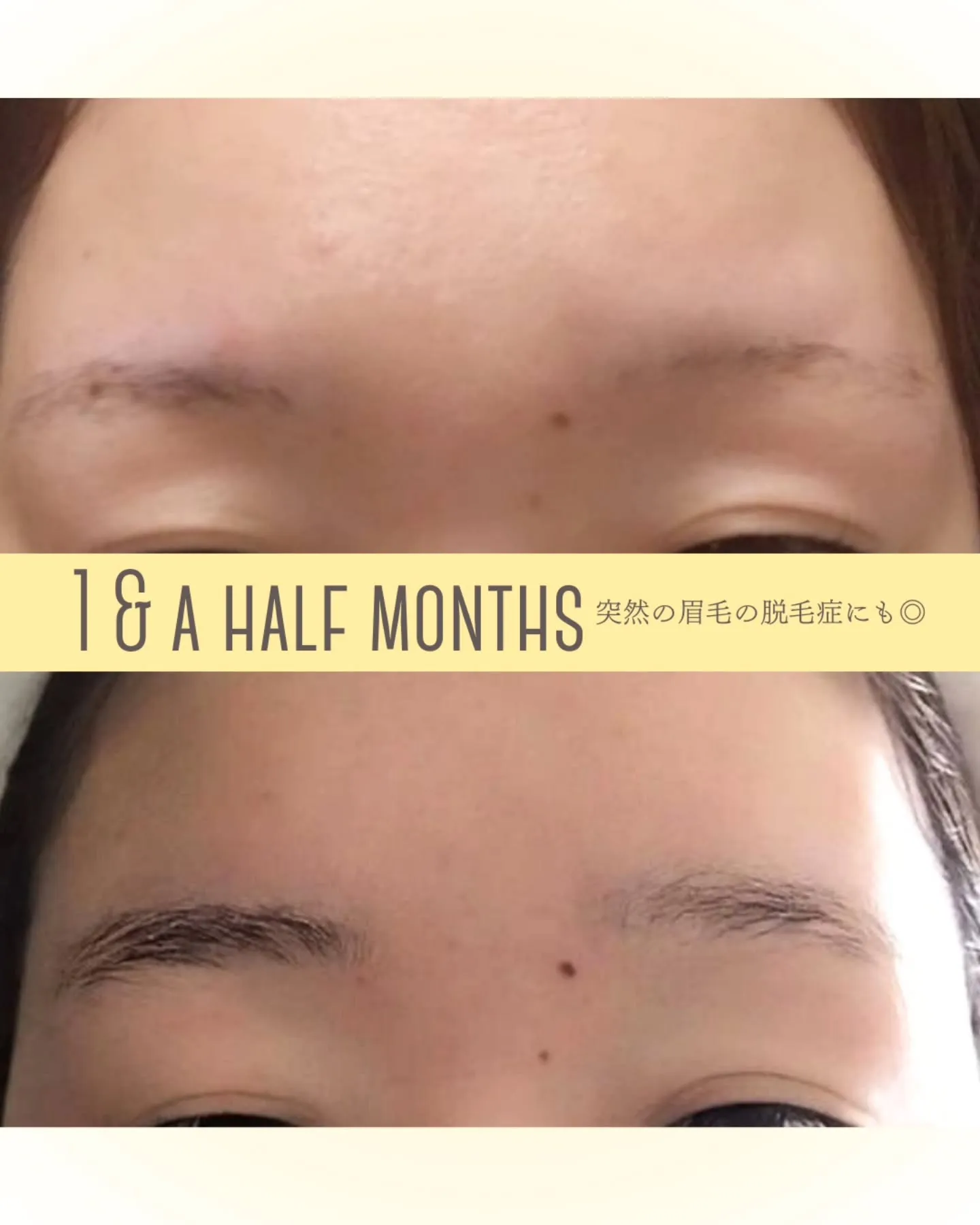 【脱毛症は頭だけじゃないし、でもなんとかなる!】