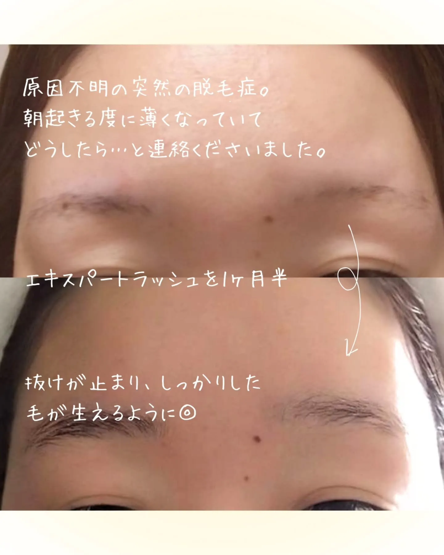 【脱毛症は頭だけじゃないし、でもなんとかなる!】